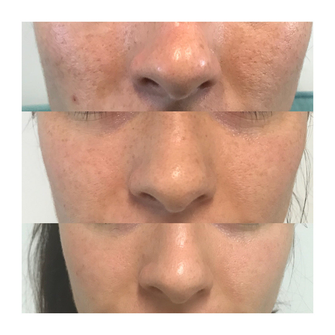 ZenCell™ Acne Blemish Skin Restore Serum