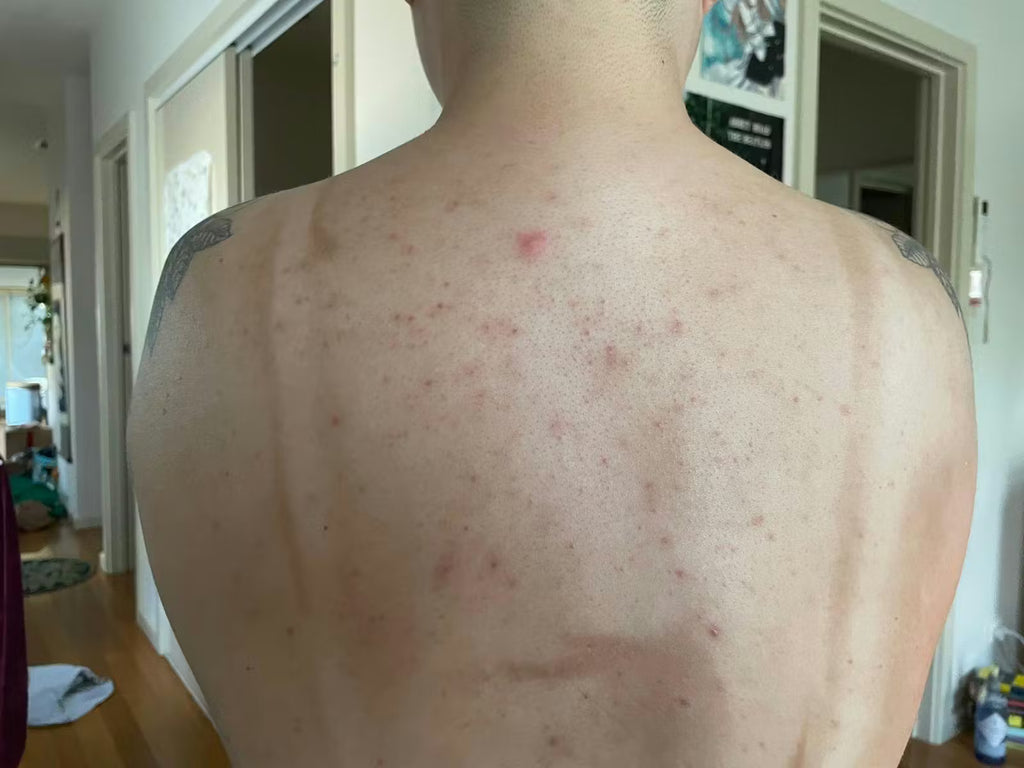 ZenCell™ Acne Blemish Skin Restore Serum