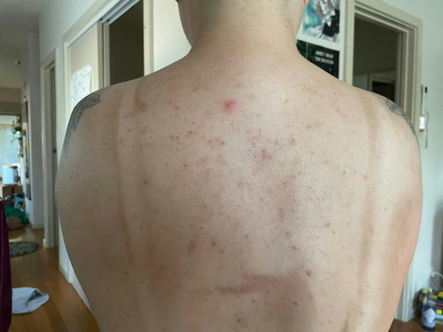 ZenCell™ Acne Blemish Skin Restore Serum