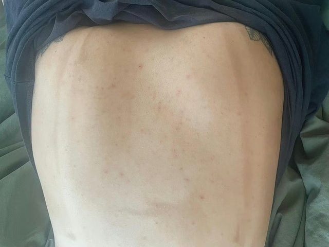 ZenCell™ Acne Blemish Skin Restore Serum