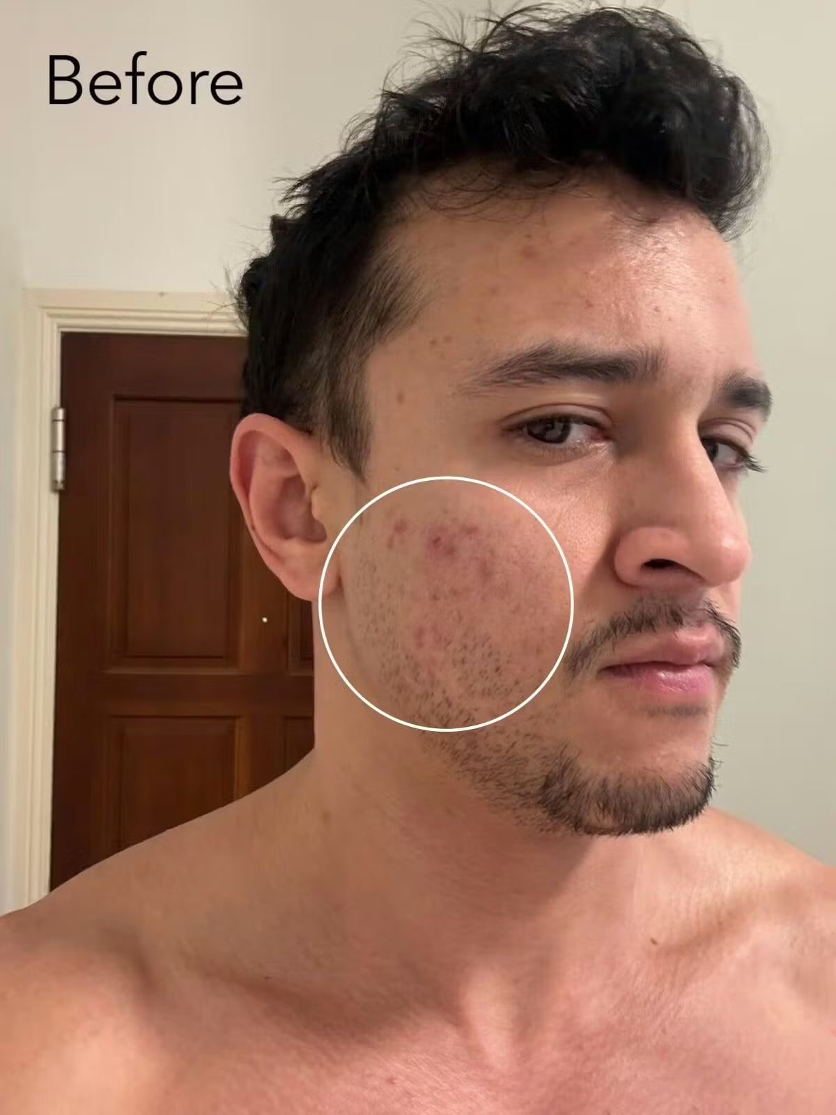 ZenCell™ Acne Blemish Skin Restore Serum