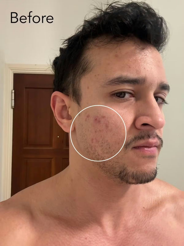 ZenCell™ Acne Blemish Skin Restore Serum