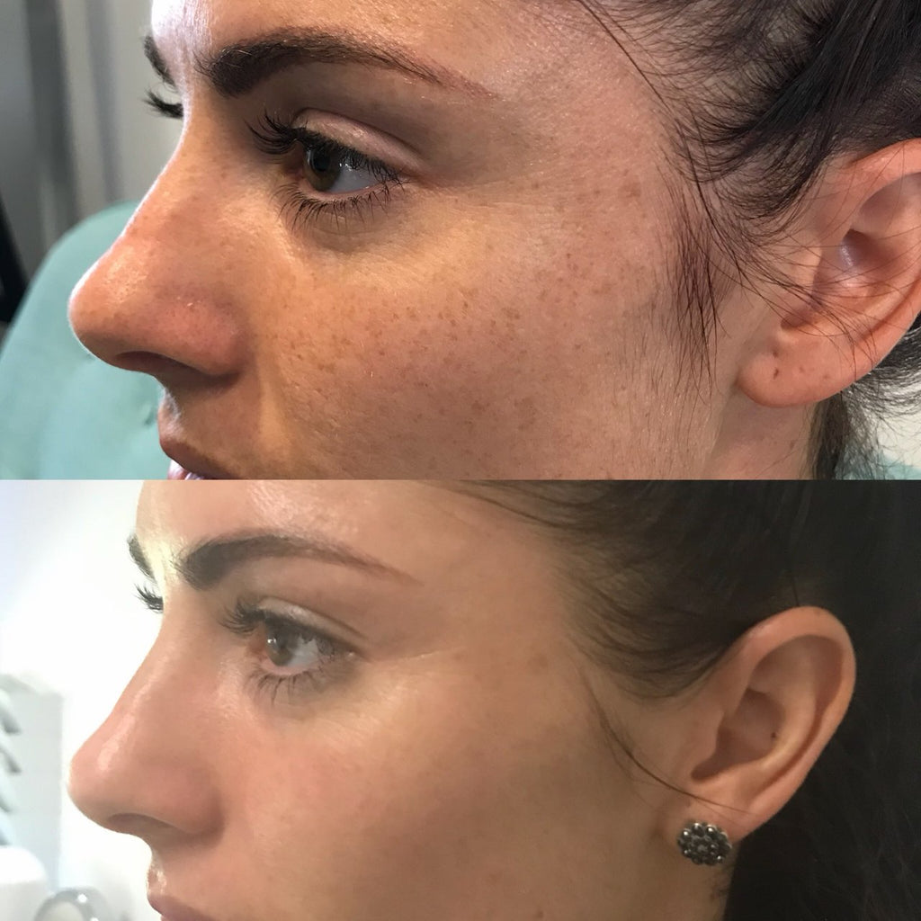 ZenCell™ Acne Blemish Skin Restore Serum