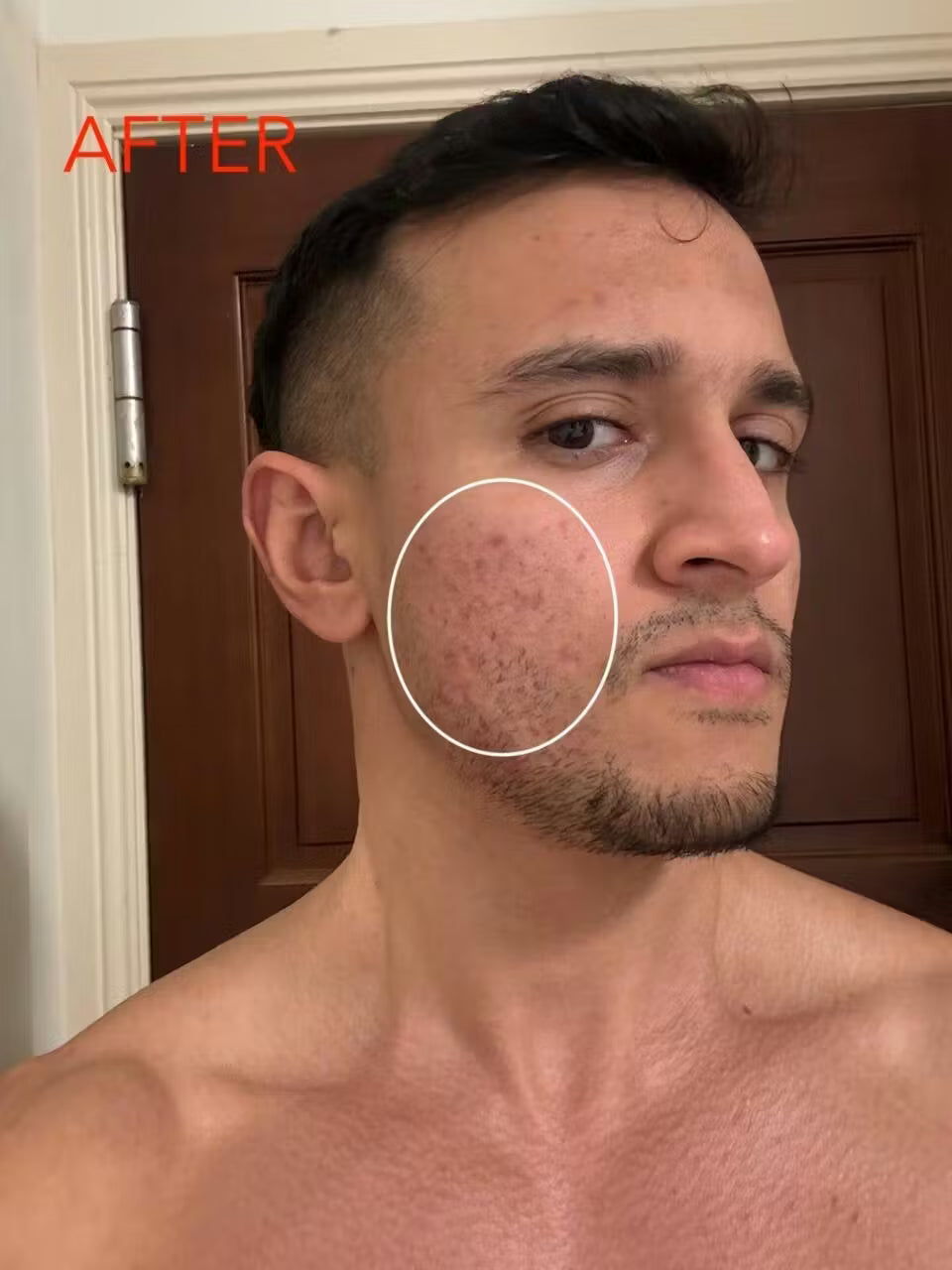 ZenCell™ Acne Blemish Skin Restore Serum