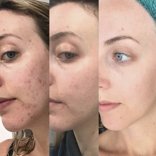 ZenCell™ Acne Blemish Skin Restore Serum