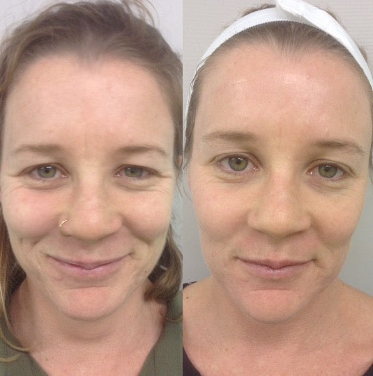 ZenCell™ Acne Blemish Skin Restore Serum